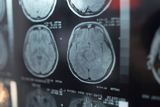 recreational drug use stroke risk brain scans t