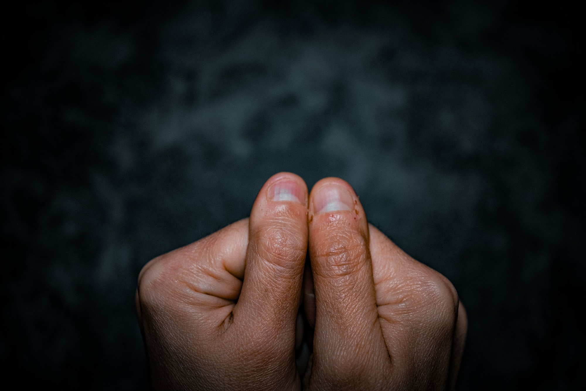 how gross is biting your fingernails bloody cuticles